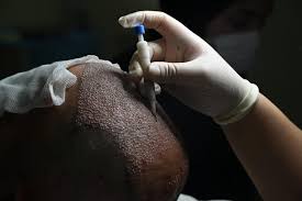 DHI Hair Transplant Technique