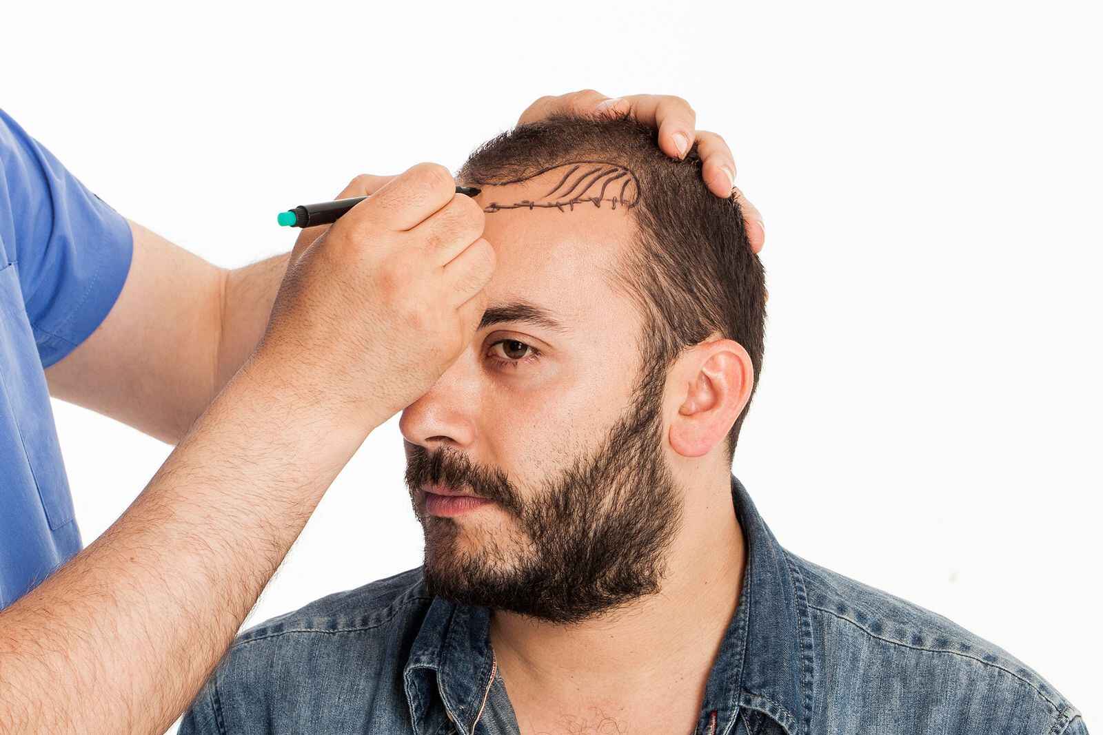Hair Transplant Repair & Corrections